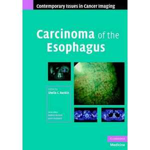 Carcinoma of the Esophagus imagine