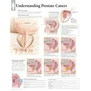 Understanding Prostate Cancer Laminated Poster - Scientific Publishing imagine