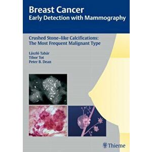 Breast Cancer: Early Detection with Mammography. Crushed Stone-like Calcifications: The Most Frequent Malignant Type, Hardback - Peter B. Dean imagine
