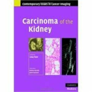 Carcinoma of the Kidney - Uday Patel imagine