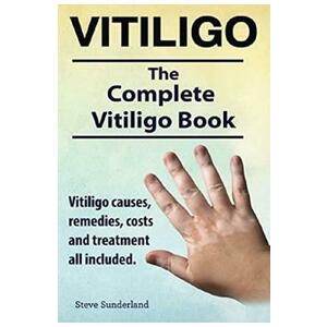 Vitiligo - Steve Sunderland imagine
